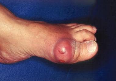 Gout and Pseudogout: Practice Essentials, Background, Pathophysiology