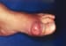 Gout and Pseudogout