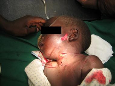 A Zone II penetrating neck injury in a young boy. 