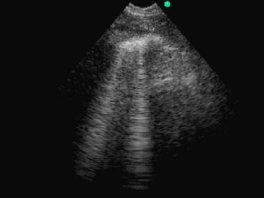 Thoracic ultrasonography: comet tail sign. Patient