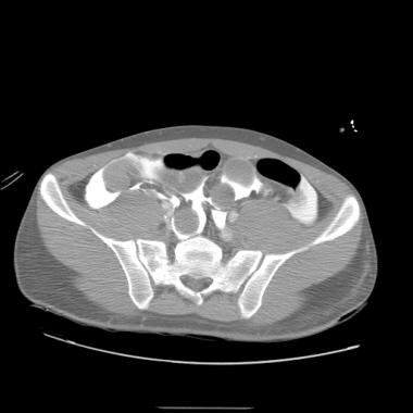 Extravasated contrast in abdominal cavity secondar