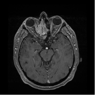Axial MRI T1 with contrast of the same patient in 