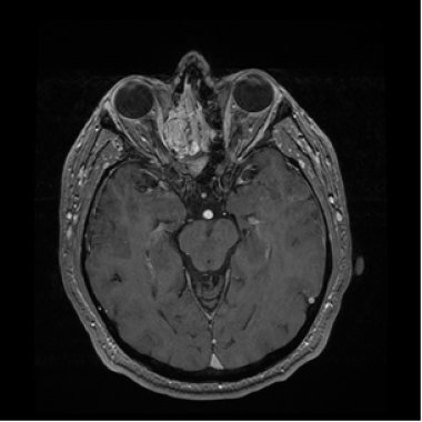 同一病人的轴位MRI T1对比图