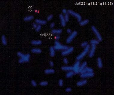 Velocardiofacial综合症。染色体fluorescenc