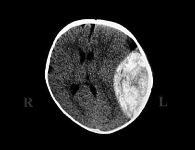 Pediatric Head Trauma. Epidural hematoma with midl