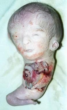 The parasitic twin (sacrificed) after separation. 