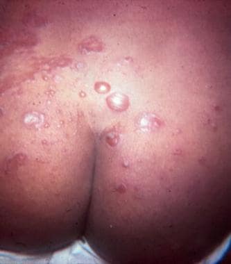 bullous impetigo in children