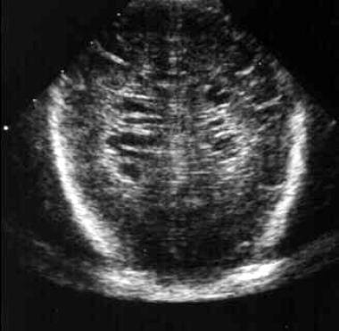 Pediatric Periventricular Leukomalacia. Cranial ul