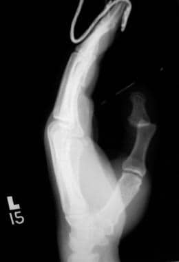 Dorsal thumb interphalangeal dislocation. 
