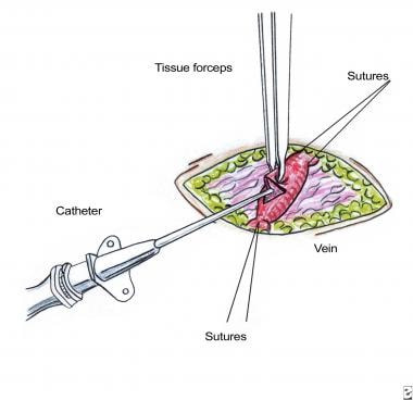 Insertion of saphenous vein catheter. After vein i