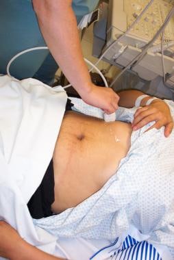 Longitudinal probe placement for biliary ultrasono