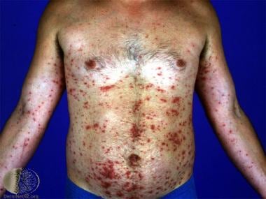 Figure, Tinea Barbae DermNet New Zealand] - StatPearls - NCBI