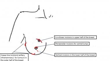 Lumpectomy: Overview, Periprocedural Care, Technique