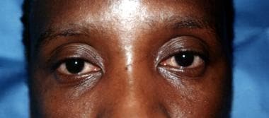 Bulbar conjunctiva congestion in a patient with mu