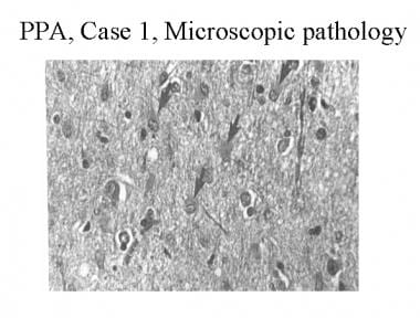 Hematoxylin and eosin stain of the left frontal co