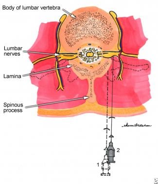 Lumbar paravertebral somatic block technique. See 