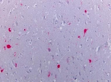 Neocortex stained with tau. Tau positive tangles i