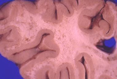 This sliced fixed brain shows multiple isolated or