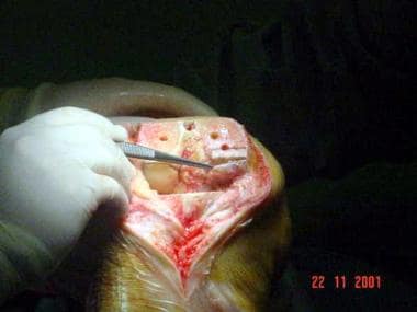 Revision to a total knee arthroplasty. The medial 