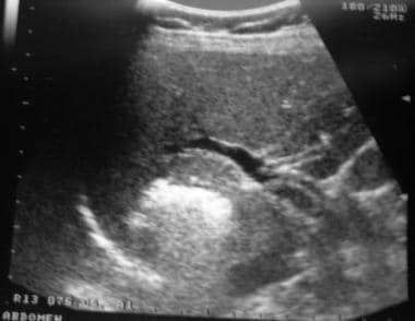 Ultrasound image of liver after radiofrequency abl