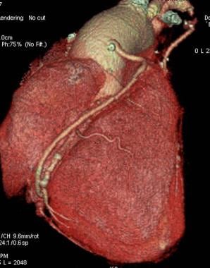 Saphenous vein graft: Volume-rendered CT image of 