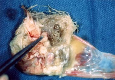 Laparoscopic resection of a torted ovarian dermoid cyst