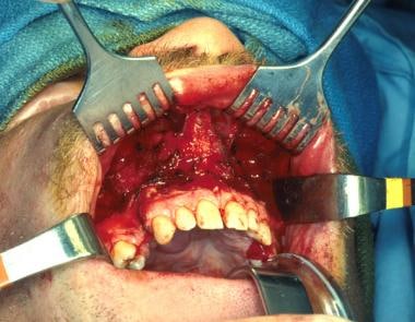 Gingivobuccal sulcus incision often utilized for e