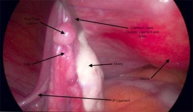 Ligamento uteroovariano grampeado e trompa de Falópio.