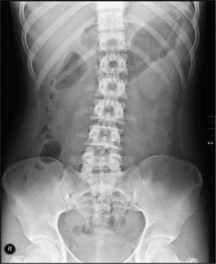 Normal KUB (kidney, ureter, bladder) radiograph. C