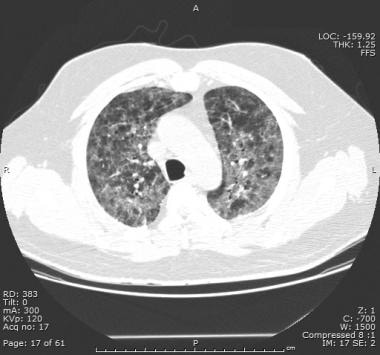 CT scan of chest, with classic patchy areas of gro
