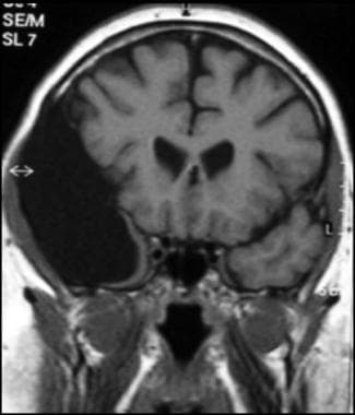 Coronal T1-weighted MRI image through a brain lesi
