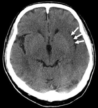 Noncontrast CT was obtained to evaluate this 64-ye