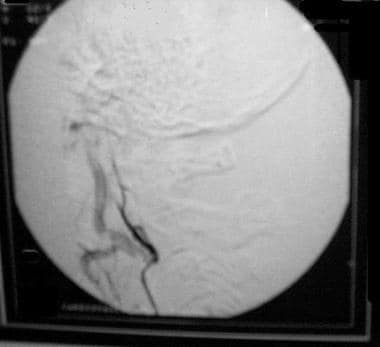 血管造影显示栓塞成功