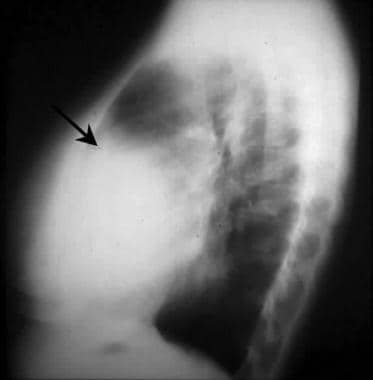 Lateral chest radiograph in an adult with Ebstein 