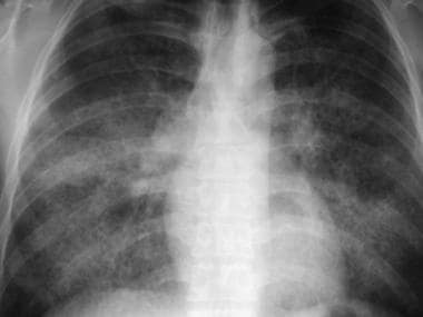 Frontal chest radiograph in a patient with pulmona