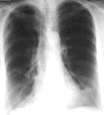 This posteroanterior chest radiograph shows hyperi