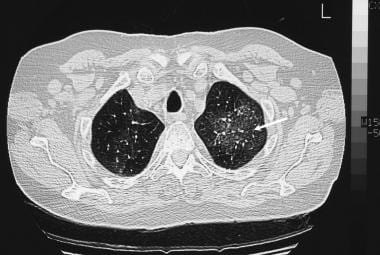 High-resolution CT (HRCT) scan in a 32-year-old ma