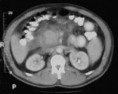 Acute pancreatitis. Focal pancreatitis involving p