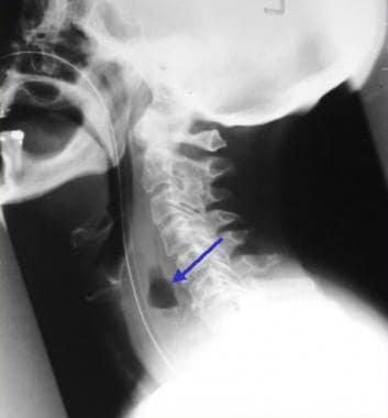 Cervical abscess following esophageal injury subse