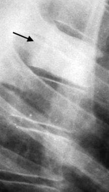 Lateral radiograph of the upper thoracic spine rev