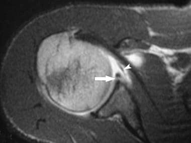 Axial, fat-suppressed, spin-echo T1-weighted magne
