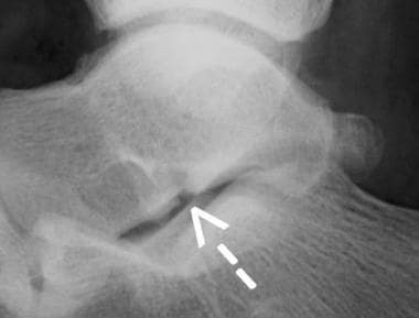 Patient OA. Lateral process of talus fracture, lat