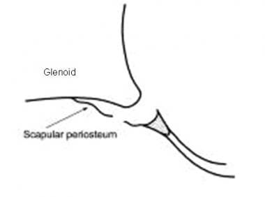 Line diagram depicting an avulsed inferior glenohu