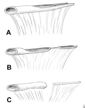 Types of duodenal recanalization anomalies. Dilata