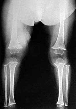 Anteroposterior radiograph of the lower extremitie
