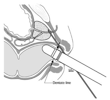 Increased pain during apical biopsy is caused by p