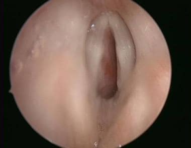 Subglottic hemangioma prior to open excision. 
