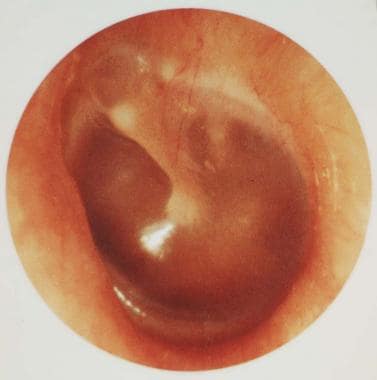 tympanic membrane abnormal