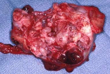 The gross specimen of a gastric teratoma after res