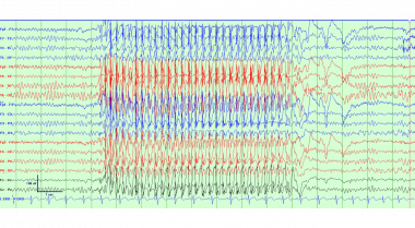 Typical absence seizure with 3-4 Hz rhythmic gener